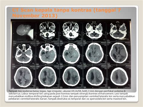 Meningioma Pembimbing Dr Suratno Spsk Ppds I Ilmu Penyakit Saraf