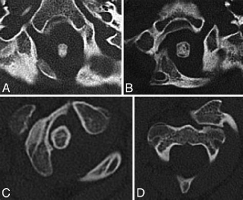 Axial Cervical Spine Ct Scans A Note Slight Rightward Rotation Of The