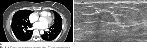 Table From Evaluation Of The Significance Of Incidental Breast