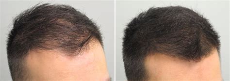 Mesotherapy For Hair Loss Dr Chen Tai Ho Malaysia