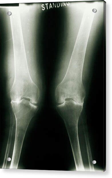 X Ray Of Knee Joints With Rheumatoid Arthritis Photograph By Medical Photo Nhs Lothianscience