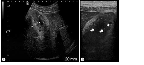 Ultrasound revealed gallbladder adenomyomatosis using different ...