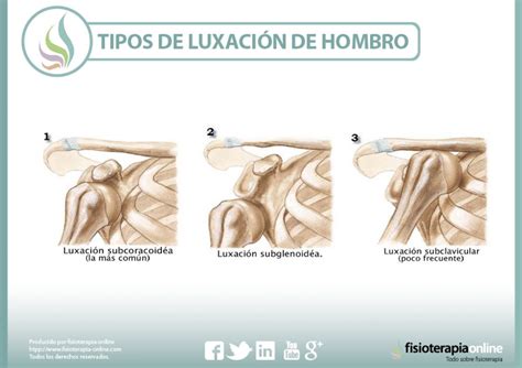 Luxaci N De Hombro Qu Es Causas S Ntomas Tratamiento Y Consejos