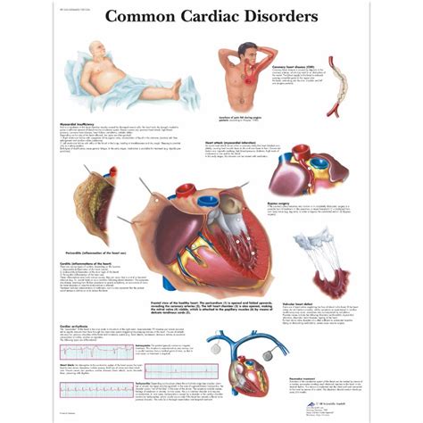 Cardiac Disorders Chart Laminated Uk