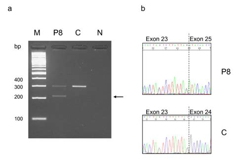 Rt Pcr Analysis In Patient 8 Mutation C2302 5 G A Showing Exon