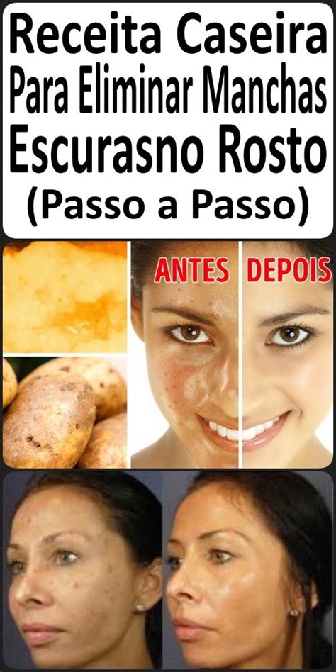 Receita Caseira Para Eliminar Manchas Escurasno Rosto Passo A Passo