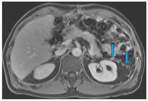 Diagnostics Free Full Text Unravelling Peritoneal Carcinomatosis