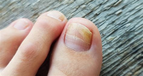 IPL Onychomycosis Fungal Nail Urban Sanctuary