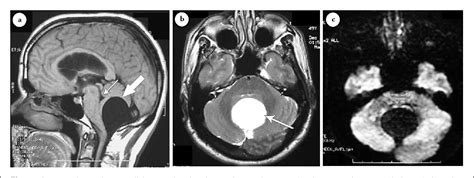 Posterior Fossa Arachnoid Cyst MRI