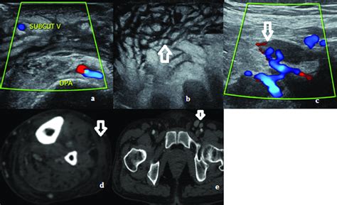 Vascular Ultrasound Of Legs