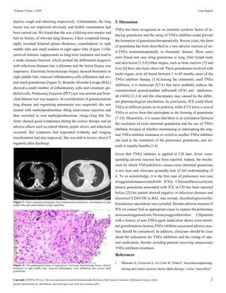 Pulmonary Noncaseating Granuloma Associated with Inflixima- bin Crohn’s ...