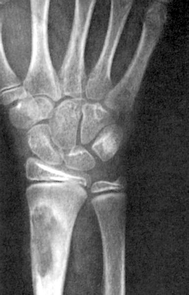 Fibrosarcoma X Ray