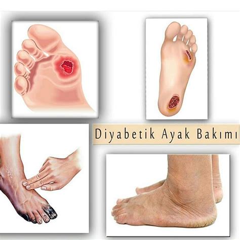 Diyabetik Ayak Nedir Diyabetik Ayak Bak M Nas L Yap L R Podiclinic