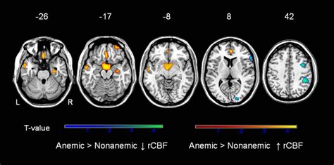 Differences In Regional Cerebral Blood Fl Ow Rcbf In Older Adults