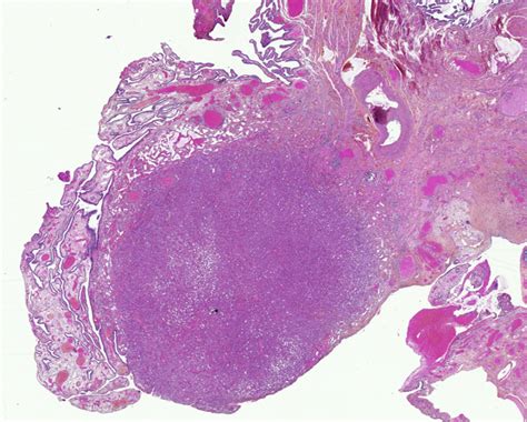 Pathology Outlines Adenomatoid Tumor Peritoneum