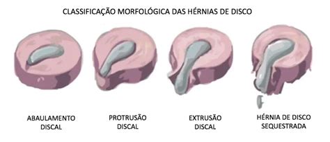 Protus O Discal Tem Cura Dr William Zarza