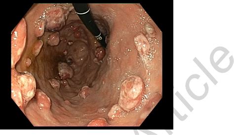 Figure From Digestive Pseuodpolyposis As A Form Of Presentation Of