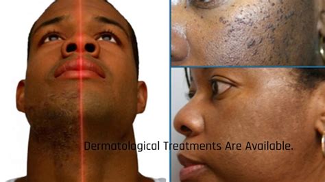 Darker Skin Conditions Keloids An Advanced Dermatology Associates 212 262 2500 Youtube