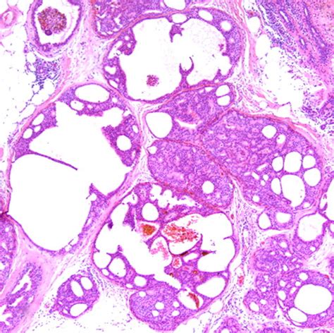 Complex Cystic Breast Masses Diagnostic Approach And Imaging