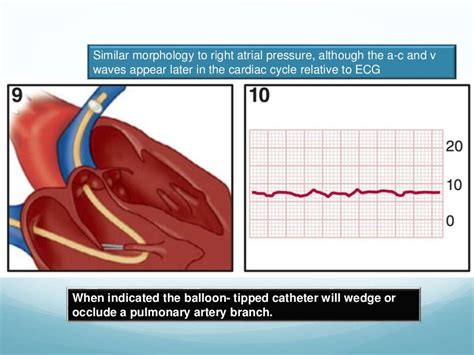 CVP Pulmonary artery wedge pressure monitoring: Physiology