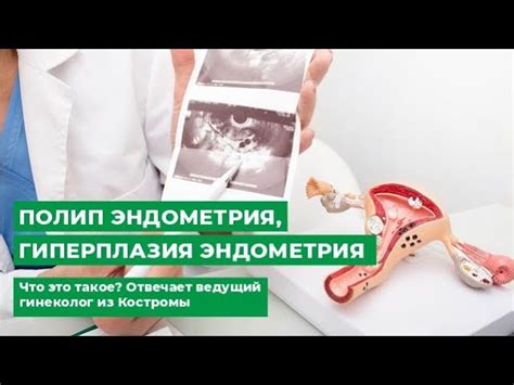 Железисто-фиброзный полип эндометрия