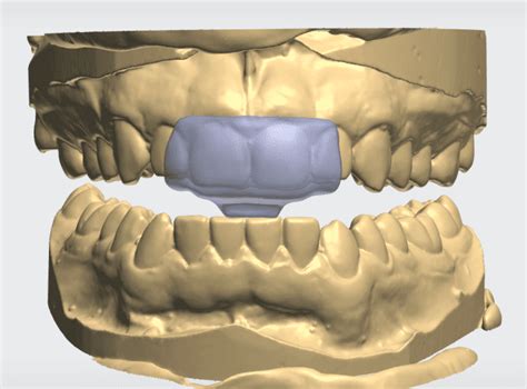 Nti Bite Splint Cad Design Cae Dental