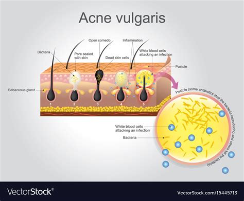 Acne Vulgaris Royalty Free Vector Image Vectorstock