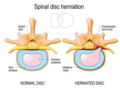 Osteo for Back Pain | Disc Prolapse vs Disc Bulges — Osteopath Hawthorn