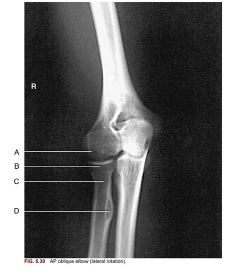 RT 131 AP Oblique Elbow Lateral Rotation Radiograph Diagram Quizlet