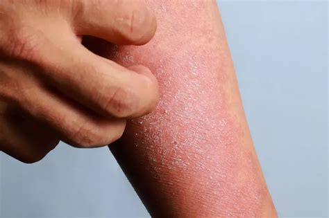 5 Common Eczema Triggers Pediatric And Adult Allergist And Allergy And