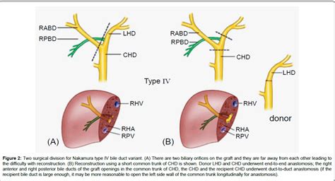 Liver Transplant Anastomosis