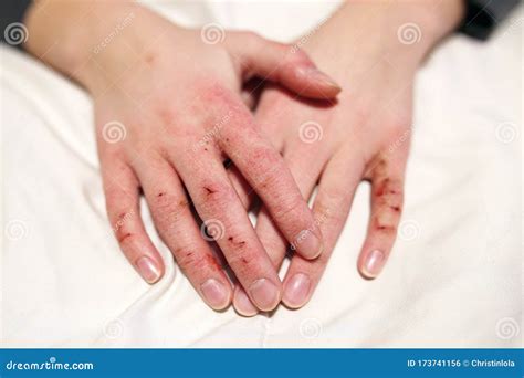 Close Up On Hands Of Child With Severely Cracked And Dry Skin Stock