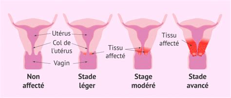Progression du cancer du col de l utérus