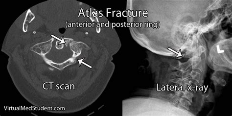 Atlas Fractures Medical Pictures Atlas Radiology