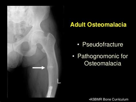 Bone Trek The Next Generations Of Drugs For Osteoporosis Osteoarthr…