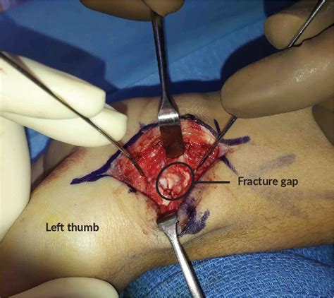 Figure 1 From The Functional Outcomes Of Scaphoid Nonunion With