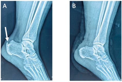 Jpm Free Full Text Treatment Of Calcific Insertional Achilles Tendinopathy Knotless