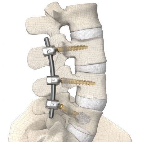 胸腰椎脊柱内固定系统 DIPLOMAT Signus Medical 后入路