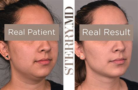 Cheek Liposuction Buccal Fat Removal Reduce Chubby Face In Nyc