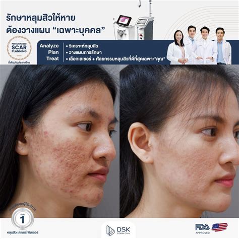 Personalized Scar Planning รักษาหลุมสิวให้หาย ต้องวางแผนเฉพาะบุคคล