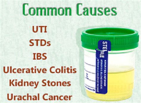 Mucus In Urine Updated