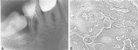 Figure 2 From The Incidence Of Cysts And Tumors Around Impacted Third Molars Semantic Scholar