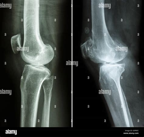 Normal Knee X Ray Stock Photos Normal Knee X Ray Stock Images Alamy