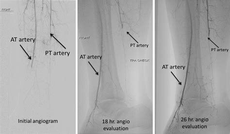 Anterior Tibial Arteries