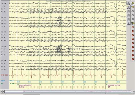 Figure 12 Photic Stimulation Photic Stimulation Responses