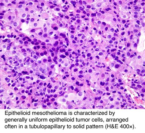 Mesothelioma With Epithelioid Cells Pathology Outlines