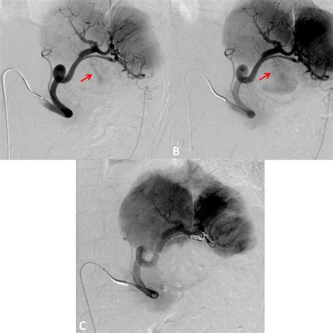 A And B Splenic Artery Angiogram Depicting A Fine Jet Of Contrast