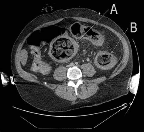 Clozapine Induced Stercoral Colitis A Surgical Perspective Bmj Case Reports