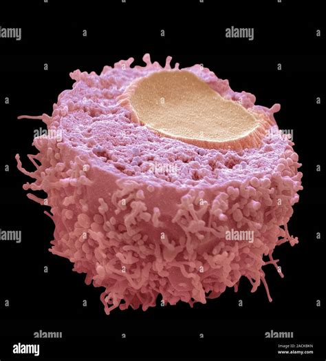 Cervical Cancer Cell Coloured Scanning Electron Micrograph Sem Of A