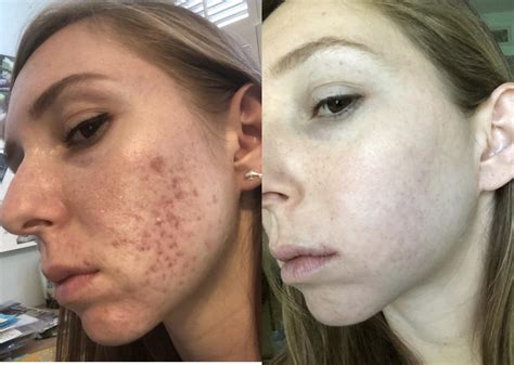 First Day Last Day 8 Months 40mg Then 60mg R Accutane